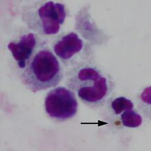 Thick film: neutrophil pigment