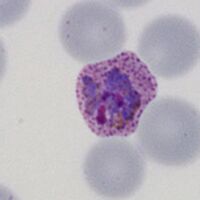 Amoeboid parasite, distorted red cell